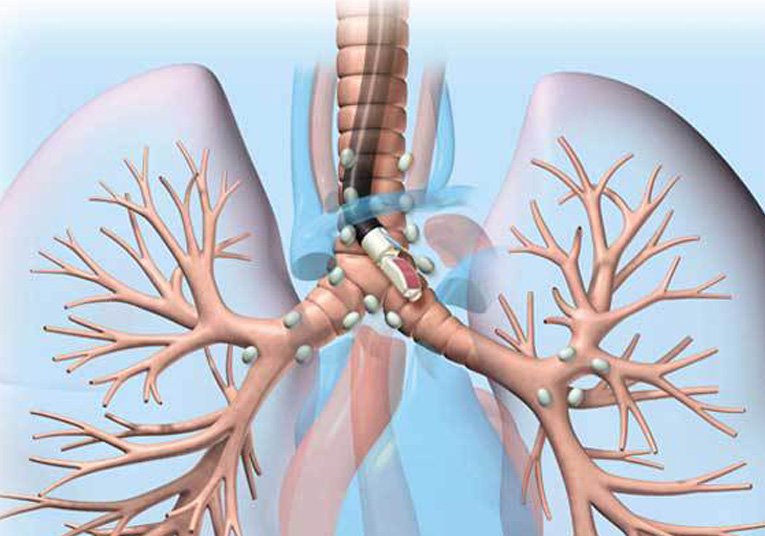 endobronchialultrasound img